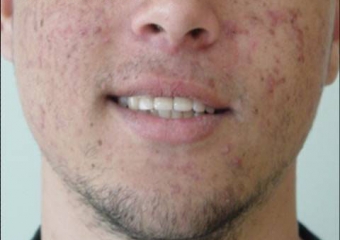 Sorriso final do caso terminado em agosto de 2007 - Clínica Cliniface