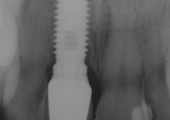 Rx do implante com a prótese instalada. - Clínica Cliniface