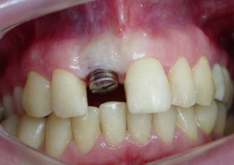 Imagem de um implante com cicatrizador e com o dente provisório removido. - Clínica Cliniface