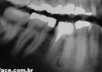 Raio X periapical inicial - Clínica Cliniface