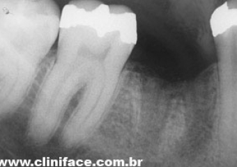 Raio X após a extração do dente comprometido - Clínica Cliniface