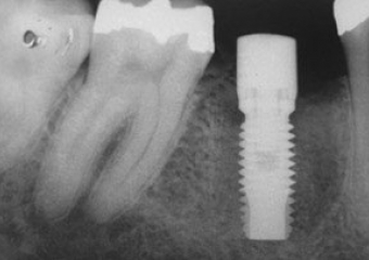 Raio X após a instalação do implante - Clínica Cliniface