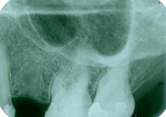 Raio X após a extração - Clínica Cliniface