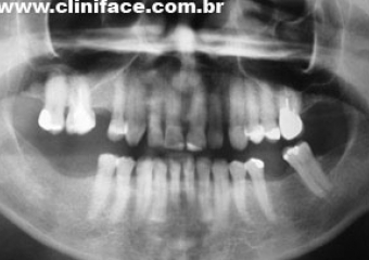 Raio X inicial - Clínica Cliniface