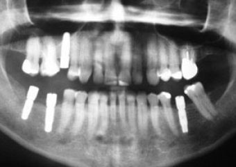 Raio X com implantes instalados - Clínica Cliniface