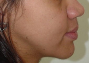 Imagem perfil após cirurgia - Clínica Cliniface
