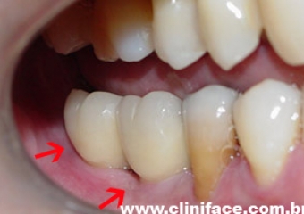 Imagens com prótese fixa em porcelana sobre implantes do caso finalizado em janeiro de 2009 - Clínica Cliniface
