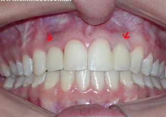 Imagem das próteses instaladas sobre os implantes - Clínica Cliniface