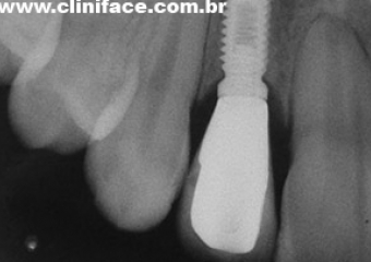 Imagens de implantes em incisivo lateral direito e esquerdo instalados - Clínica Cliniface