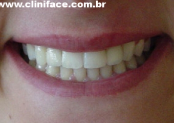 Imagem final do caso terminado em janeiro de 2008 - Clínica Cliniface