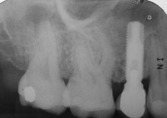 Raio X com Implante Instalado - Clínica Cliniface