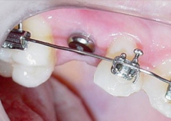 Imagem Inicial - Implante Instalado - Clínica Cliniface