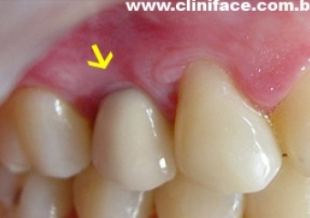 Imagem Final do caso terminado em dezembro de 2004. - Clínica Cliniface