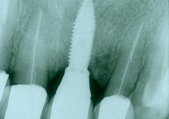 Raio X do implante e prótese fixa em porcelana - Clínica Cliniface