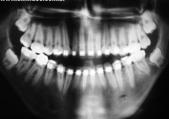 Raio x panorâmico inicial - Clínica Cliniface