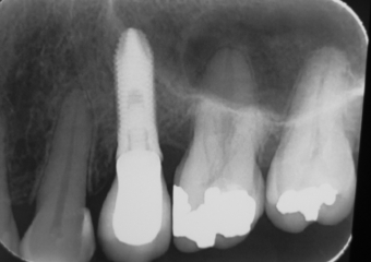 Raio X com prótese fixa em porcelana instalada sobre o implante - Clínica Cliniface