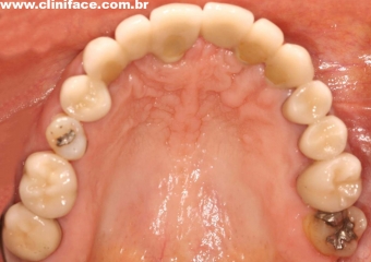 Imagens intra orais com próteses fixas em porcelana, instaladas sobre implantes - Clínica Cliniface