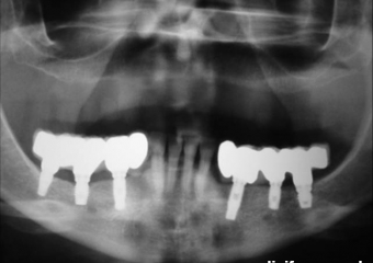 Rx com próteses fixas em porcelana instaladas - Clínica Cliniface