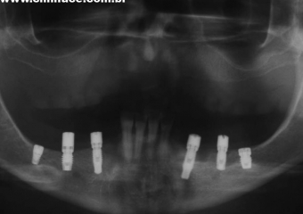 Raio X com implantes instalados - Clínica Cliniface