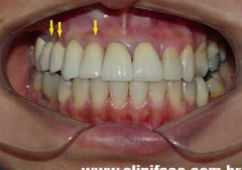 Próteses fixas de porcelana sobre implantes - Clínica Cliniface