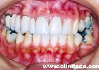  Imagem intra oral inicial - Clínica Cliniface