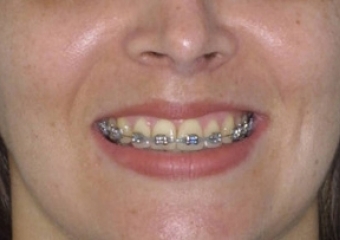 Imagem inicial após a cirurgia - Clínica Cliniface