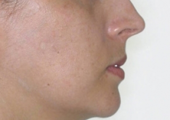 Perfil após a cirurgia  - Clínica Cliniface