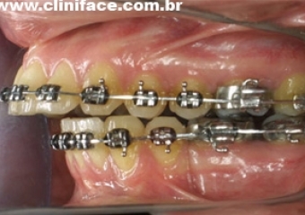 Mordida inicial - Clínica Cliniface