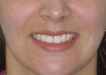 imagem final após a remoção do aparelho - Clínica Cliniface