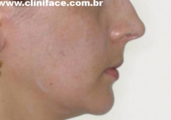 Perfil final após a remoção do aparelho - Clínica Cliniface