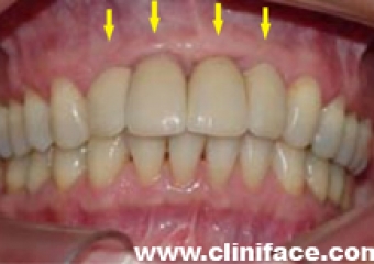 Próteses unitárias em porcelana sobre implantes - Clínica Cliniface