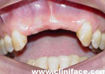 Imagem intra oral inicial - Clínica Cliniface