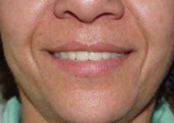 Sorriso final do caso terminado em setembro de 2009 - Clínica Cliniface