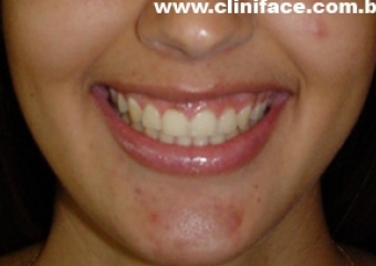 Imagem frontal após remoção do aparelho - Clínica Cliniface