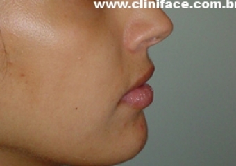 Perfil após a remoção do aparelho - Clínica Cliniface