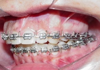 Mordida inicial - Clínica Cliniface