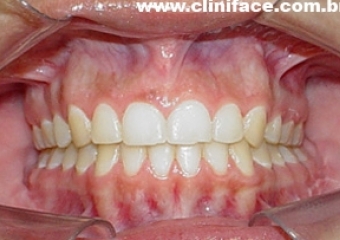 Mordida após a remoção do aparelho - Clínica Cliniface