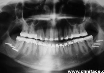 Raio x panorâmico final - Clínica Cliniface