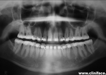 Raio x panorâmico inicial - Clínica Cliniface