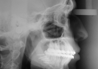 Telerradiografia final - Clínica Cliniface