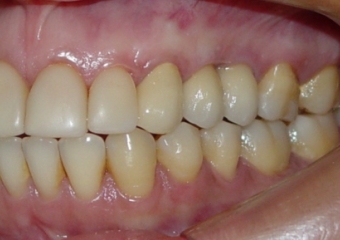 Imagem e sorriso final do caso terminado em junho de 2011 - Clínica Cliniface