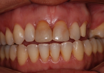 Imagens iniciais observando importante perda óssea e dentária superior - Clínica Cliniface