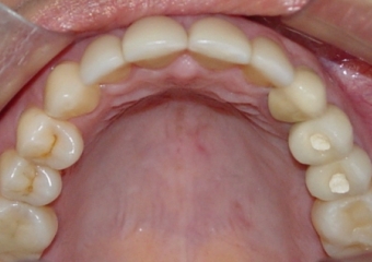Próteses fixas de porcelana instaladas - Clínica Cliniface