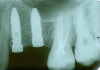 Raio X dos implantes instalados - Clínica Cliniface
