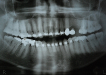 Rx mostrando a ausência de dois pré molares superiores - Clínica Cliniface