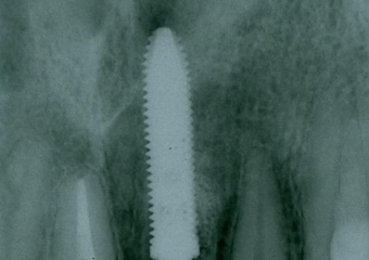 Raio X com dente de porcelana instalado - Clínica Cliniface