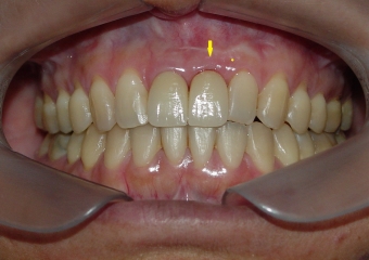  Imagem final do caso terminado em janeiro de 2013 - Clínica Cliniface