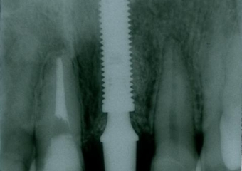 Raio X com implante e prótese provisória fixa - Clínica Cliniface