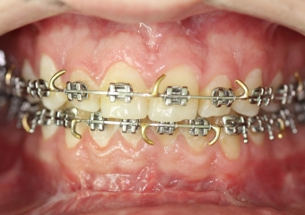 Mordida após a cirurgia - Clínica Cliniface