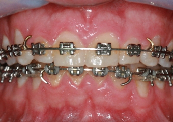 Mordida inicial - Clínica Cliniface